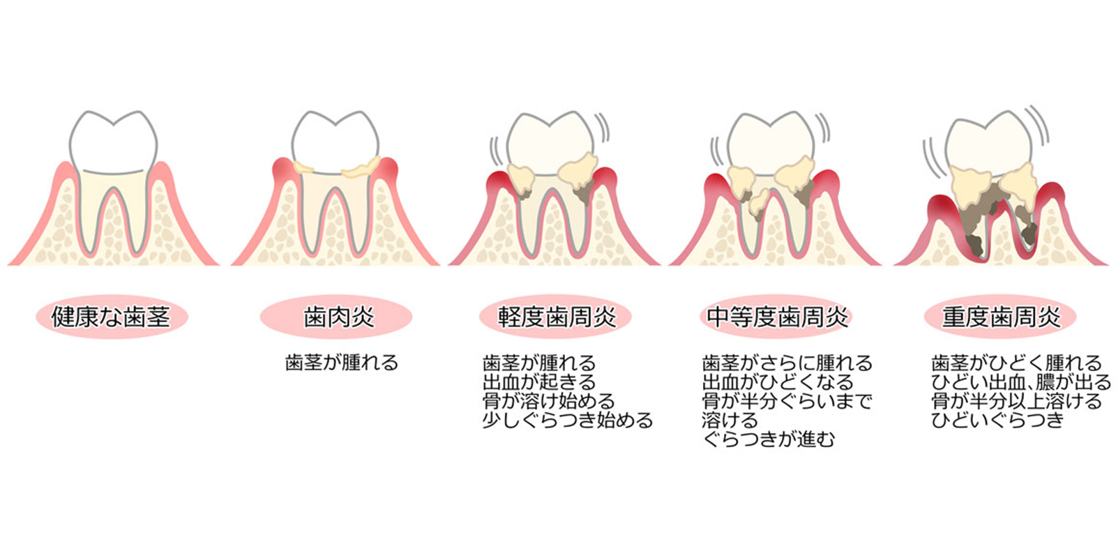 歯周病治療について