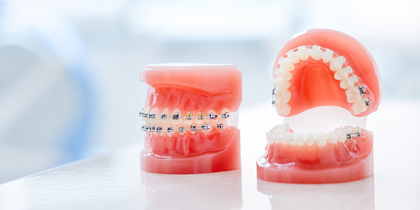 ワイヤー矯正について