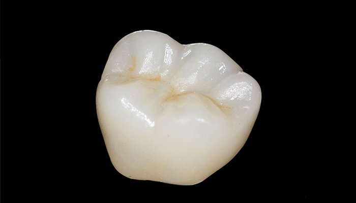 セラミッククラウン