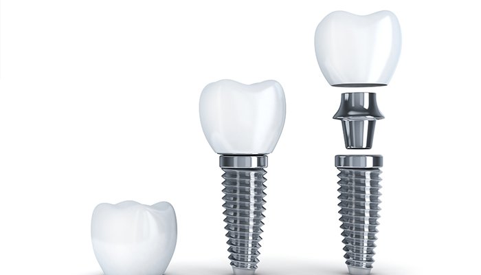 アバットメント・プロビジョナル装着