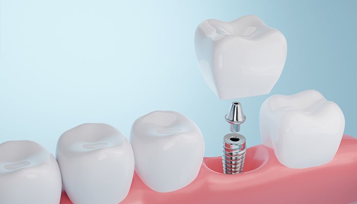 上部構造（クラウン）