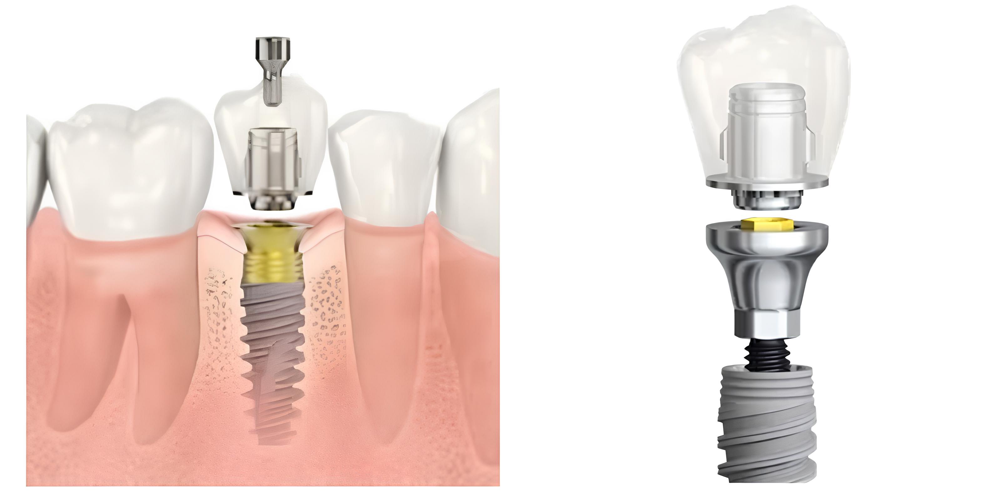 インプラントについて